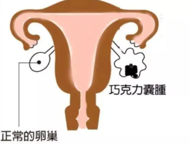 爱之晶好孕之家：巧克力囊肿你知道是怎么回事吗？对生育的影响是否严重？