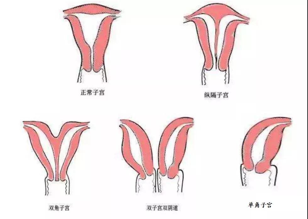 子宫畸形在爱之晶可以做试管婴儿吗？